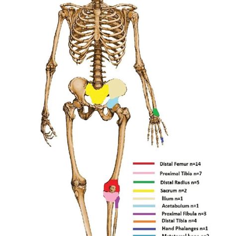 X-ray, MRI and CT images of giant cell tumor(X-ray: direct radiography;... | Download Scientific ...