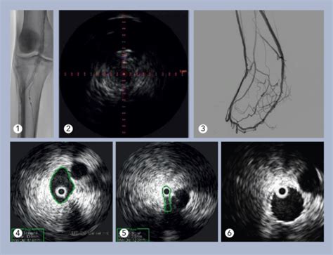 Use of IVUS reduces patient risk of MALE or death by up to 28%