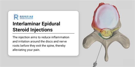 Interlaminar Epidural Steroid Injections NJ | Redefine Healthcare