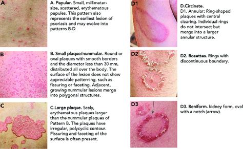 Annular Lesions: Diagnosis And Treatment AAFP, 40% OFF