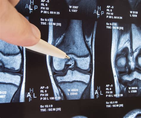 What To Do About Bone-On-Bone Knee Pain