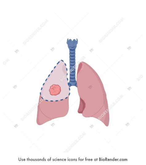 Free Lung cancer surgery (lobectomy) Icons, Symbols & Images | BioRender