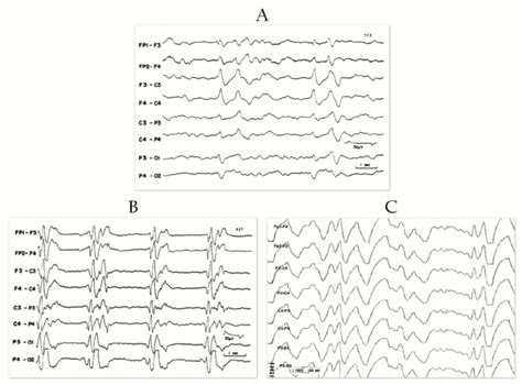 EEG in various stages of SSPE. A: The background activity is... | Download Scientific Diagram