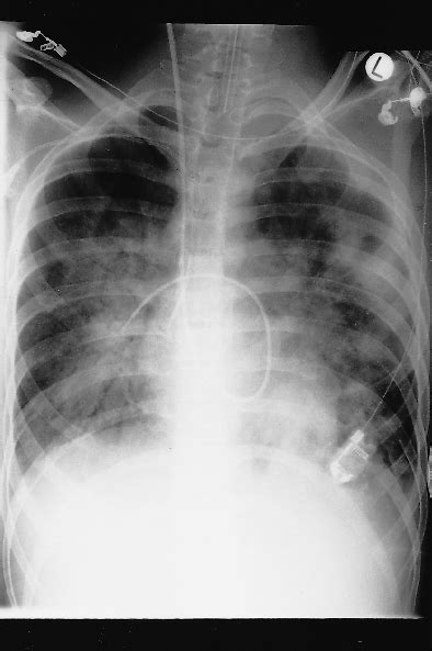 2 Chest X-ray of a patient with acute respiratory distress syndrome ...