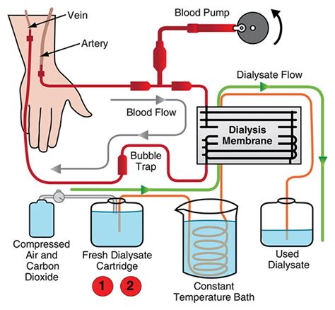 Hemodialysis Machine Procedure Parts and Function