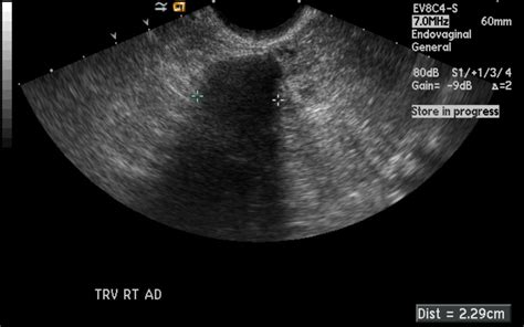 Ovarian fibroma - wikidoc