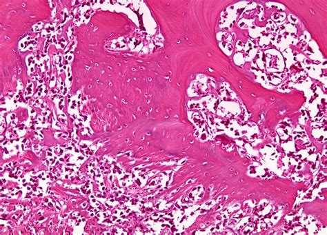 Osteogenic Sarcoma at 10x Magnification | Nikon’s MicroscopyU