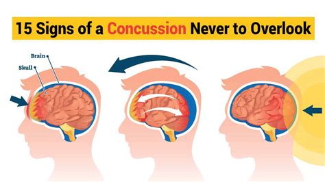 15 Signs of a Concussion Never to Overlook | 6 Minute Read