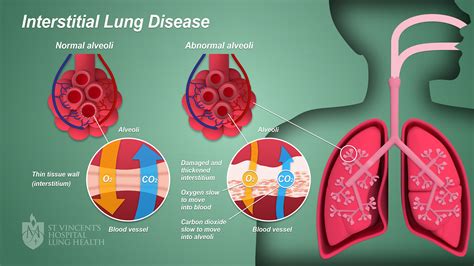 What Is Childhood Interstitial Lung Disease? - StoryMD