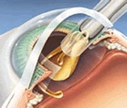 Intraocular Lens Implant (IOL) - American Association for Pediatric Ophthalmology and Strabismus