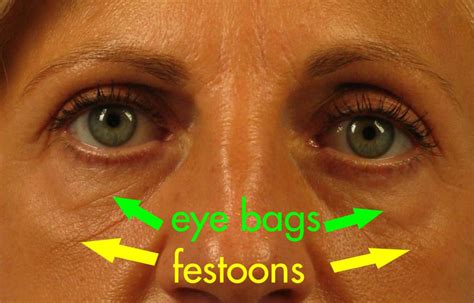 What Are Festoons? | Dr. Brett Kotlus, Cosmetic Oculoplastic Surgeon, NYC