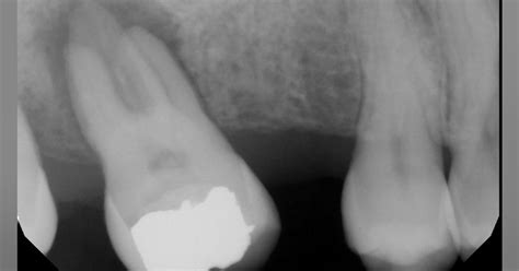 What is a periapical radiolucency? | Perio Implant Advisory