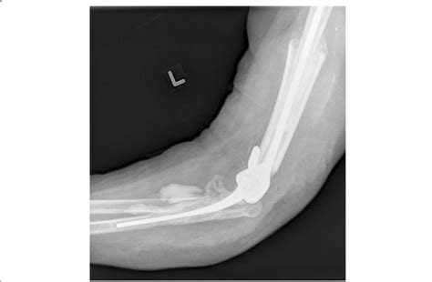 Left revision total elbow arthroplasty with cemented allograft ...