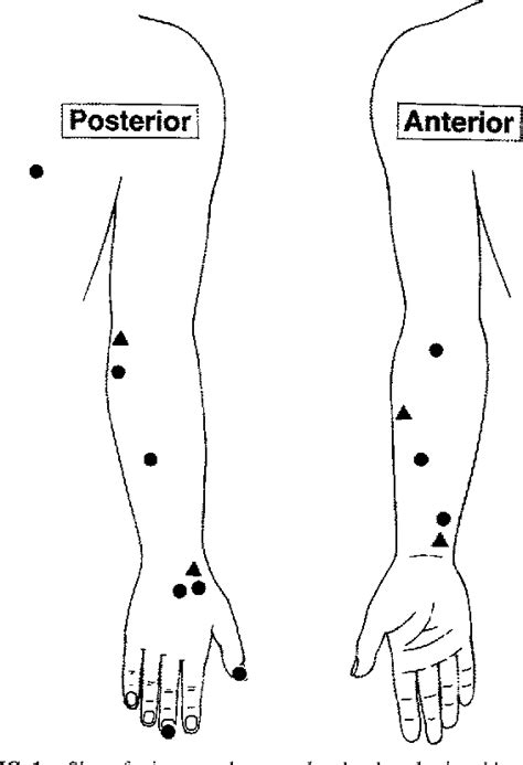 Epitrochlear lymph nodes as a site of melanoma metastasis | Semantic Scholar