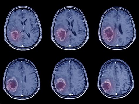 Premium Photo | Ct-scan brain imaging for hemorrhagic stroke or ischemic stroke