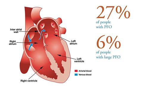 Guidelines for Patent Foramen Ovale and Fitness - DAN World