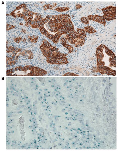 HER2 staining of gastric cancer cells. (A) HER2 immunohistochemical... | Download Scientific Diagram