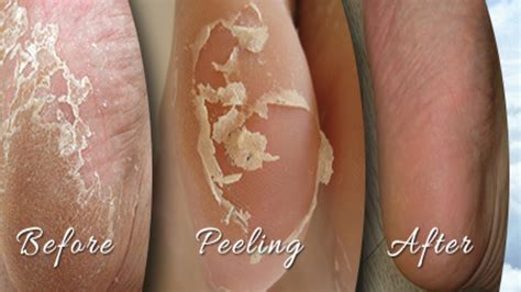 Home Remedies For Peeling Skin On Your Feet - TOP 5 DIY