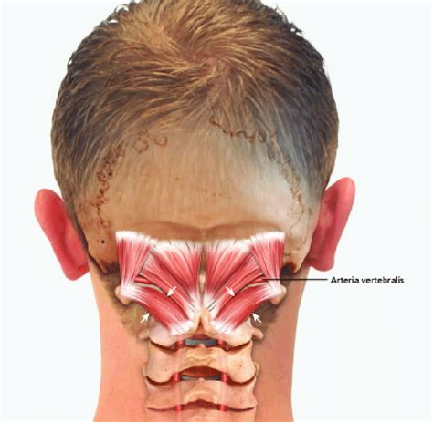 Anyone get headaches/migraines in the back of head? I tried googling to ...