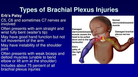 Brachial plexus birth palsy