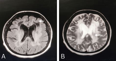 Cureus | Adult Onset Vanishing White Matter Disease: A Rare Case Report