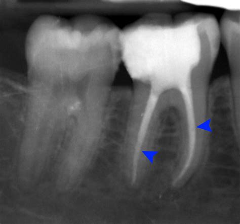 Root Canal Treatment (Endodontics) – Ryde Dental Practice