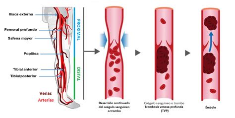 Trombosis: qué es, síntomas, causas y tratamiento