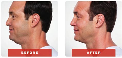 Kybella for Men - Estetika Skin & Laser Specialist