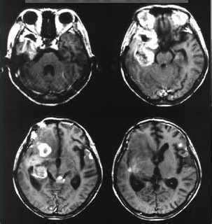 Gliosarcoma