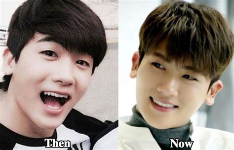 Park Hyung Sik Plastic Surgery Before and After Photos - Latest Plastic ...