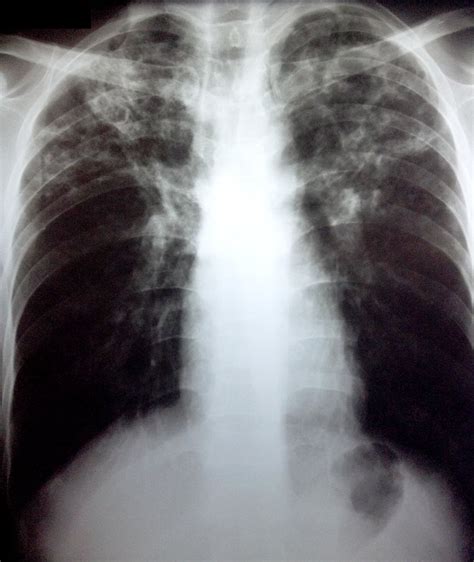 Chest X Ray Tb Vs Normal