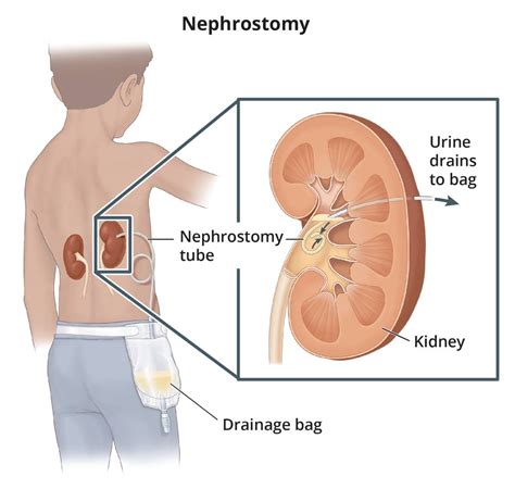 Ostomy Surgery: Ileostomy & Colostomy | UCSF Department of Surgery