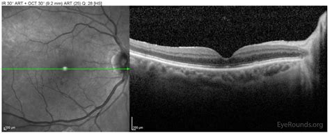 Full-Thickness Macular Hole