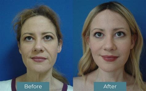 Unveiling the Benefits of Having Plastic Surgery in Turkey | by ...