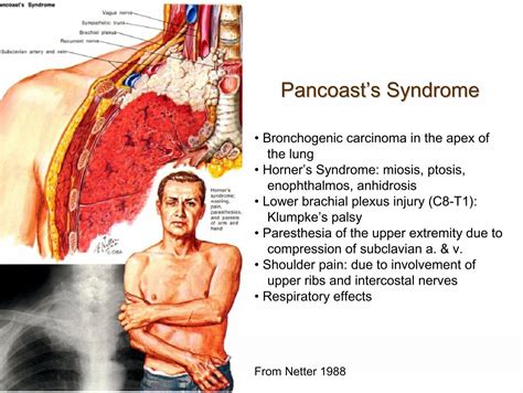 Pancoast’s Syndrome Bro