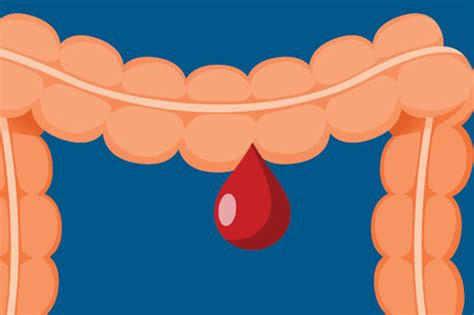 Gastrointestinal Bleeding: Causes, Types, Symptoms & Management