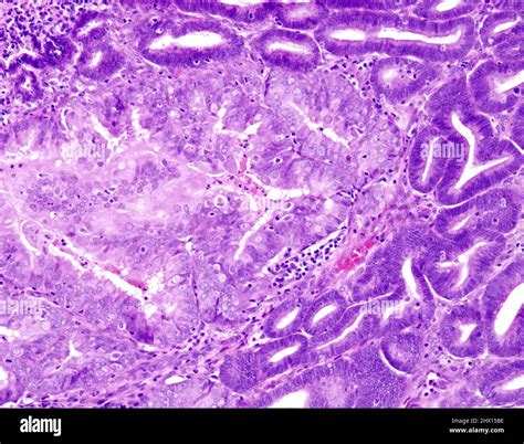 Atypical endometrial hyperplasia, light micrograph Stock Photo - Alamy