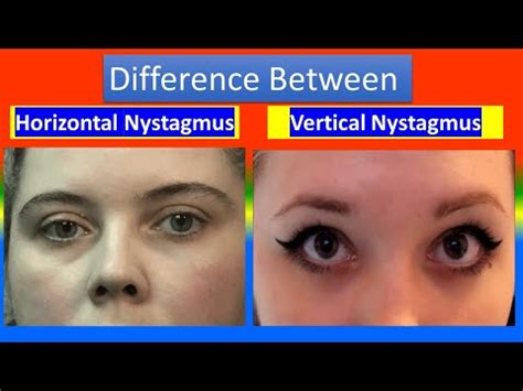 Horizontal Nystagmus Vs Horizontal Nystagmus - YouTube