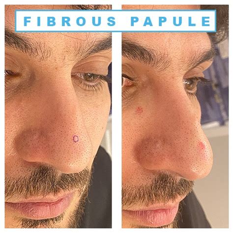 Fibrous papule | Fibrous papule of the nose | Fibrous papule treatment