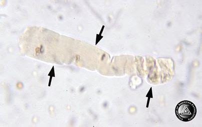 waxy casts in urine | Medical Laboratories