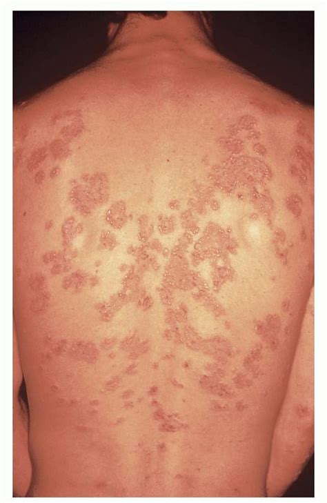 dermatitis herpetiformis pictures - pictures, photos