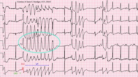 Polymorphic Ventricular Tachycardia Ecg