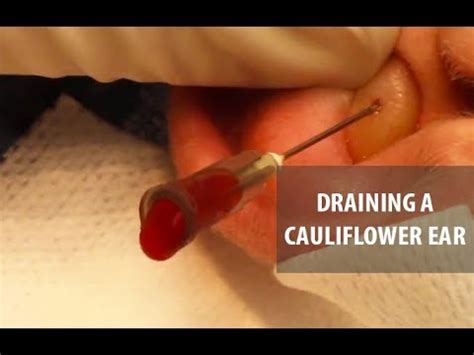 Draining a Cauliflower Ear | Dr. Derm - YouTube