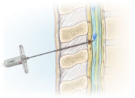 Spinal-epidural Combined Anesthesia Kits