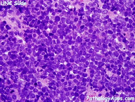 merkel cell carcinoma pathology