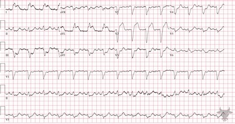 Sgarbossa Criteria | ECG Stampede