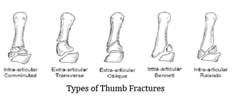 Types of Thumb Fractures - The Oshman Firm