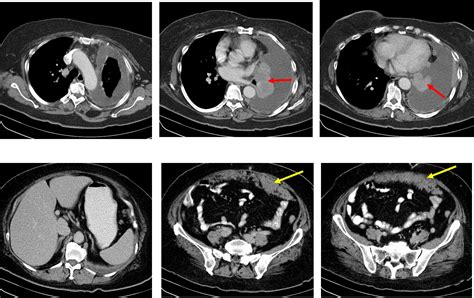 Omental cake from metastatic lung carcinoma – Radiology Cases