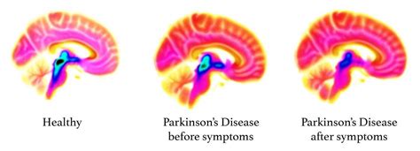 New brain imaging study reveals signs of Parkinson’s decades before ...