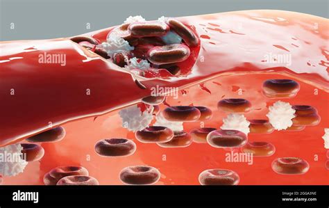 Hemostasis. Red blood cells and platelets in the blood vessel. Basic steps of wound healing ...